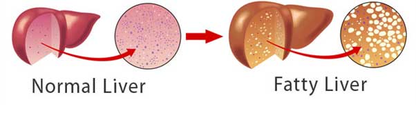 Type of Fatty Liver